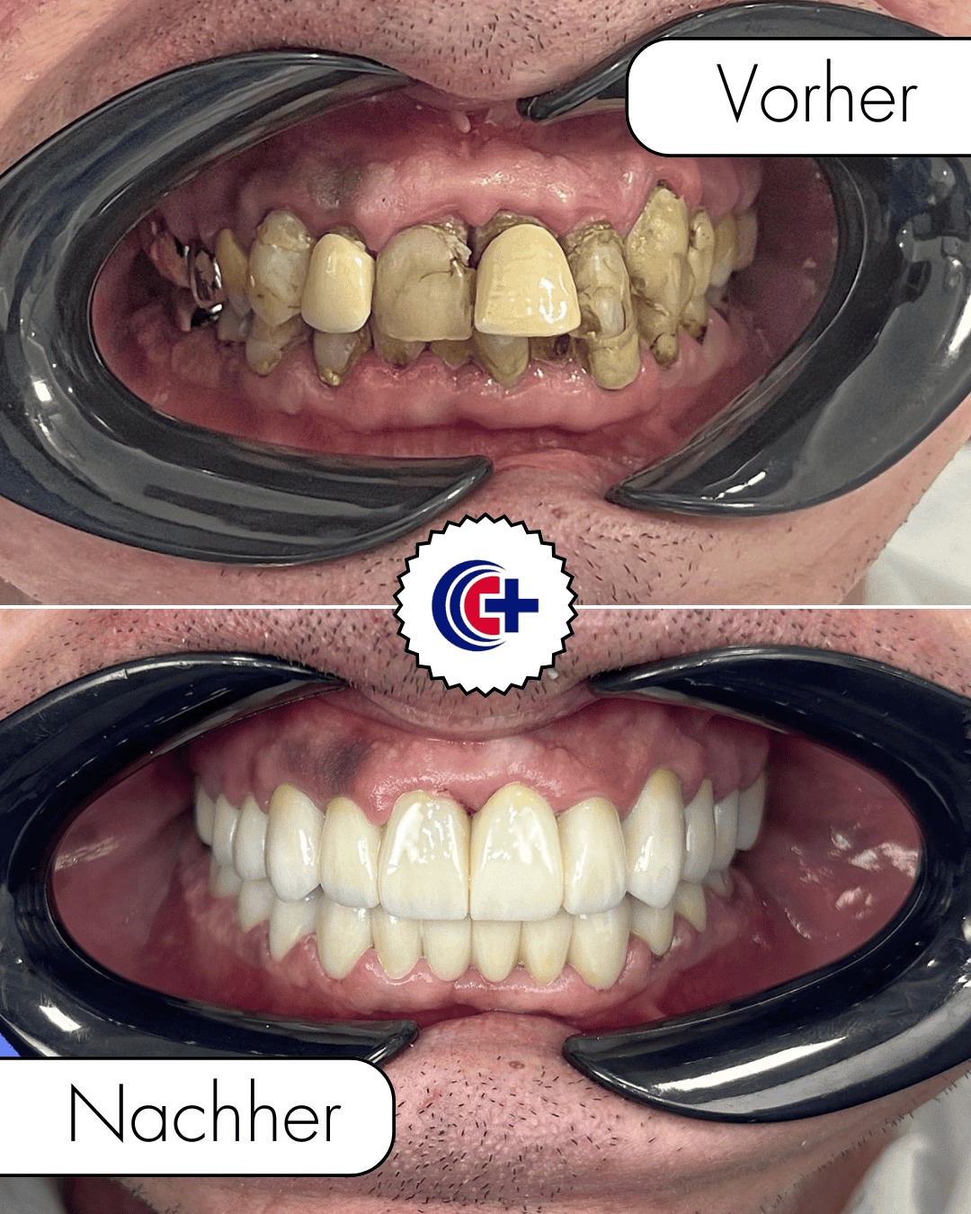 teeth before after 1