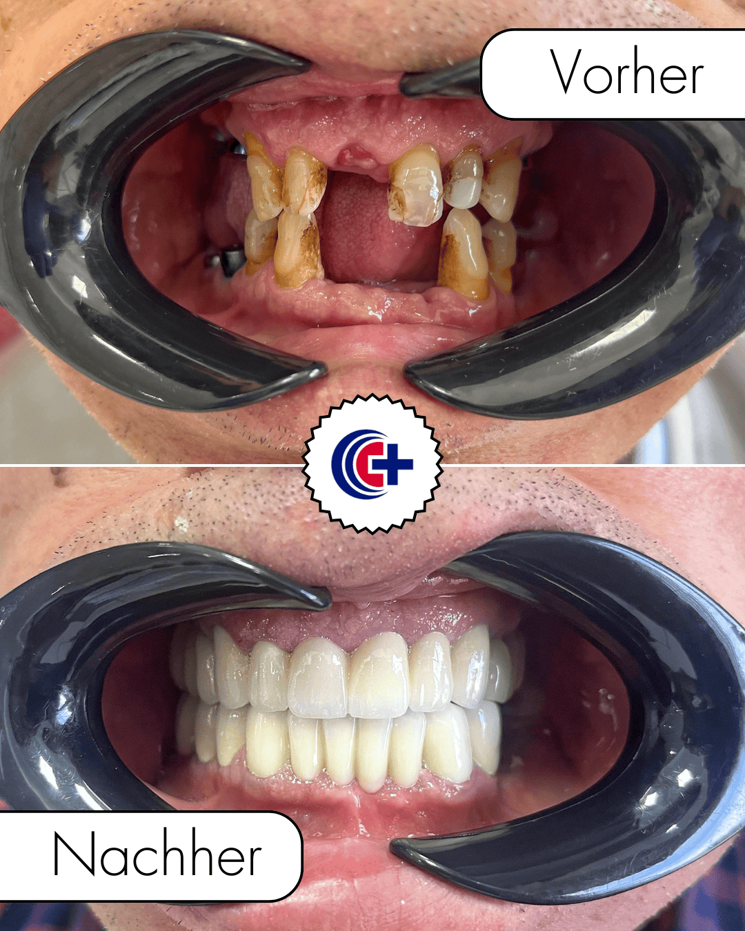 teeth before after 2