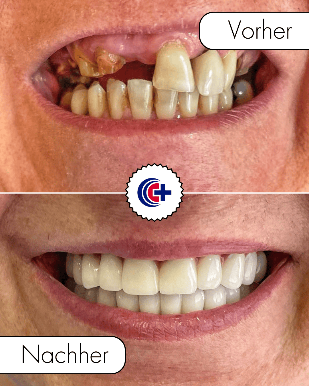 teeth before after 4